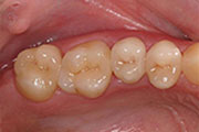 Smile makeover, Alamo
