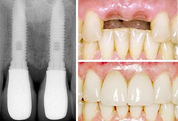 dental-implant-photo-1