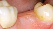 dental-implant-photo-3a