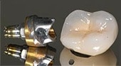 dental-implant-photo-3b