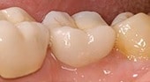 dental-implant-photo-3c