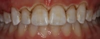 gingivectomy-after