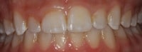 gingivectomy-before