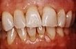 gingivitis1