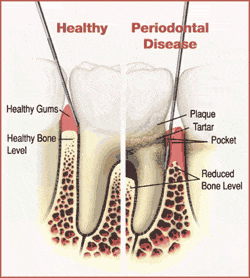 periodontal1