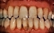 periodontitis1