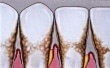 periodontitis2