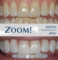 zoom_teeth_whitening_before_and_after